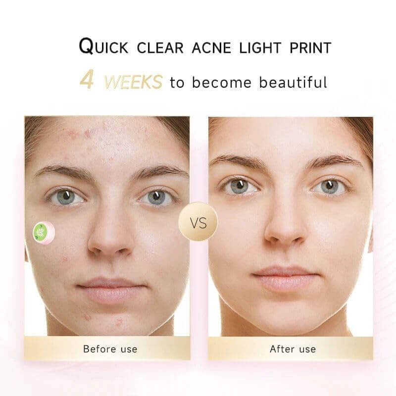 Acne Miracle