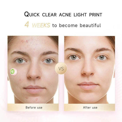 Acne Miracle